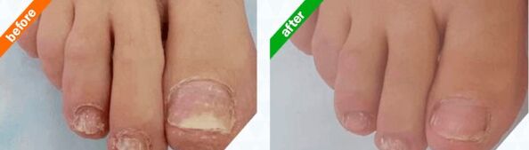 Fotos antes e despois do uso do produto, experiencias co uso de Myceril