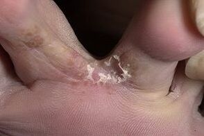 Síntomas fúngicos nos pés