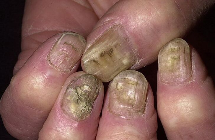 Deformación, desprendemento e desmoronamento das uñas por infección por fungos