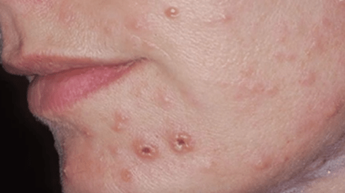 Infección fúngica da pel da cara