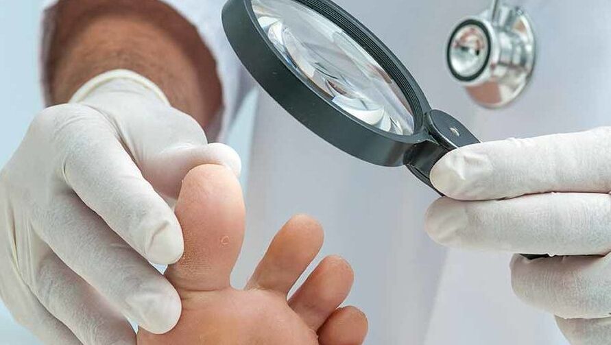 O diagnóstico do fungo da unha do pé realízao un dermatólogo